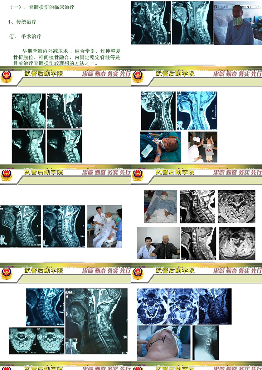 2023年脊髓損傷研究新進(jìn)展，里程碑式的突破與日常奇妙變化