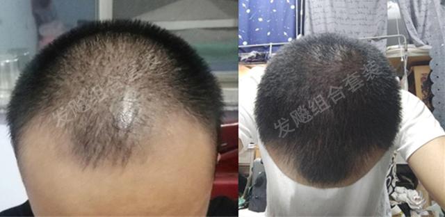 治愈脫發(fā)最新重大突破，重塑自信，希望之光再現(xiàn)