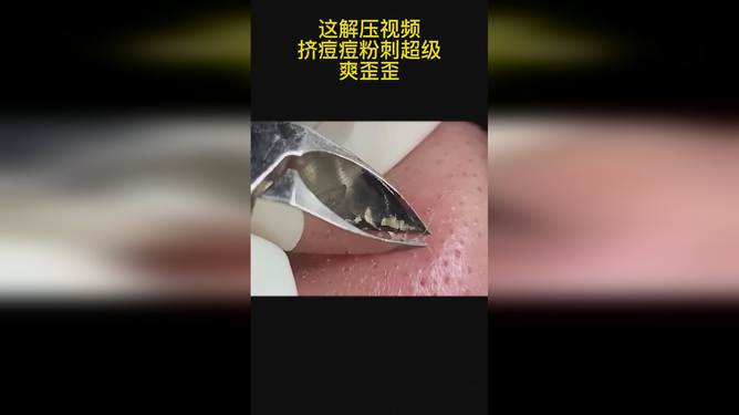 最新擠膿包視頻，見證變化的力量，自信與成就感的誕生之地